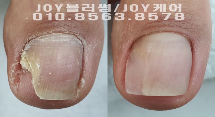  용인, 광교, 수지 발톱이 찢어지고 깨져서 고통받는 사람들을 위한 관리 잘하는 샵 추천. 문제성발톱 관리 네일샵 조이블러썸