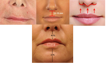입술 성형술(cheiloplasty, 입술축소 및 확대, 인중축소,입꼬리 올리기,고양이주름)