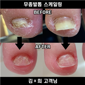 부천에서시흥까지 두꺼워진 무좀발톱은 페디아이티엔에서 관리하세요~