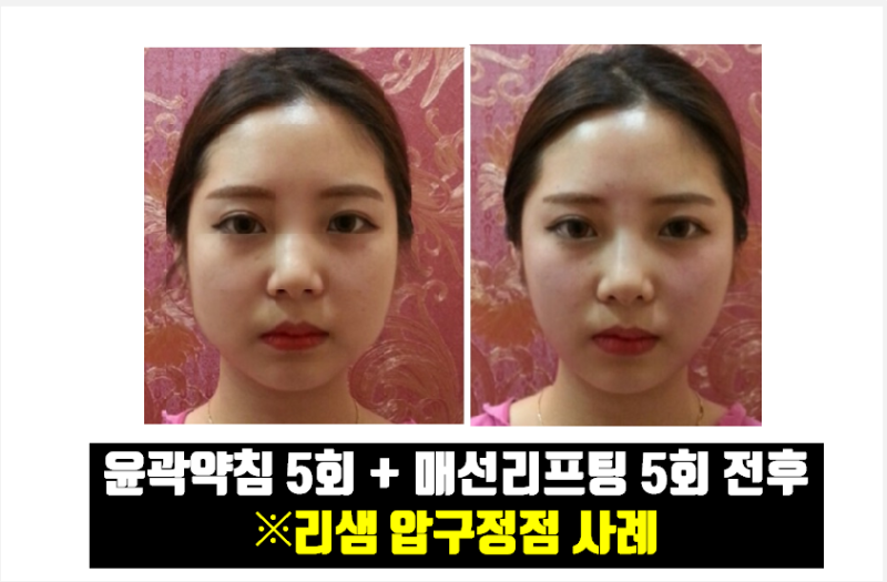 윤곽 약침: 잘 알려지지 않은 치료법에 대해 알아보자