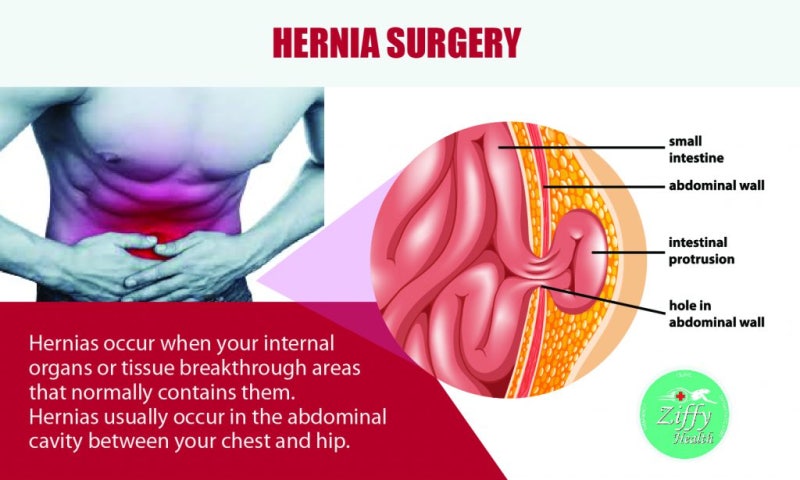 CompleteCare Health on X: Hernias occur when one of your organs