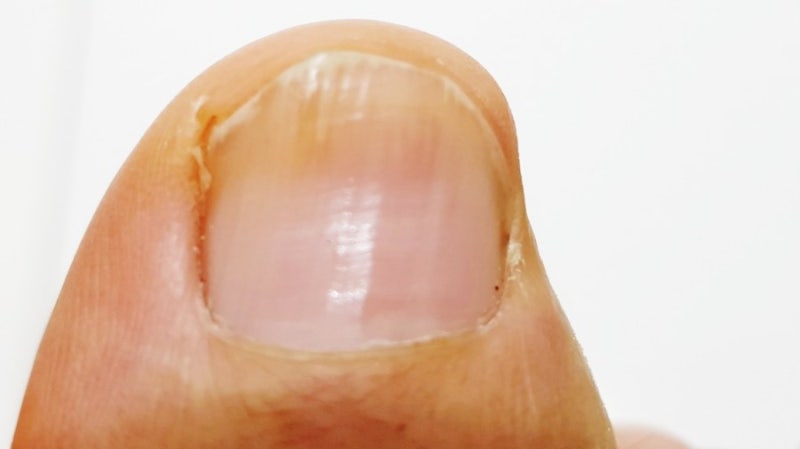 무좀균 진균 치료와 치료약에 대해서 7