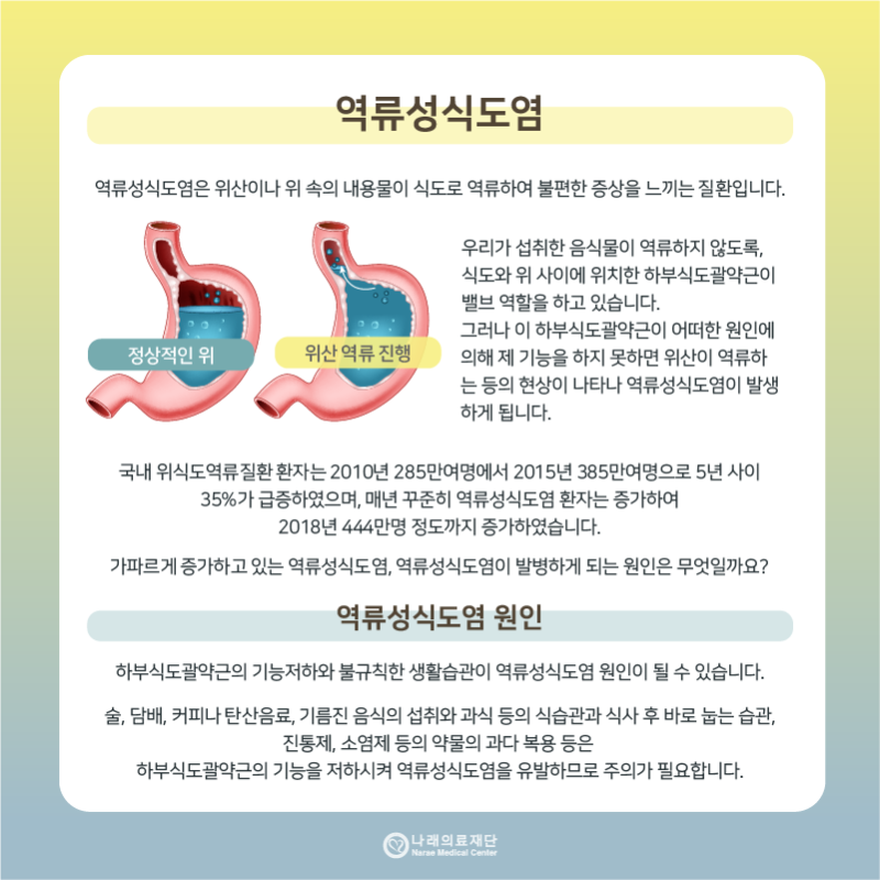 역류성 식도염의 원인증상에 따른 치료방법을