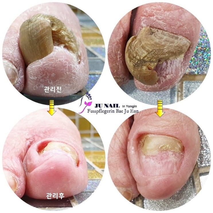 두꺼워진발톱때문에 걷기가 힘든 80세 할머니/분당용인수원수지보정동백죽전동/주네일/무좀파고드는내향성발톱손톱변형전문네일샵 두꺼워진발톱때문에 걷기가 힘든 80세 할머니/분당용인수원수지보정동백죽전동/주네일/무좀파고드는내향성발톱손톱변형전문네일샵