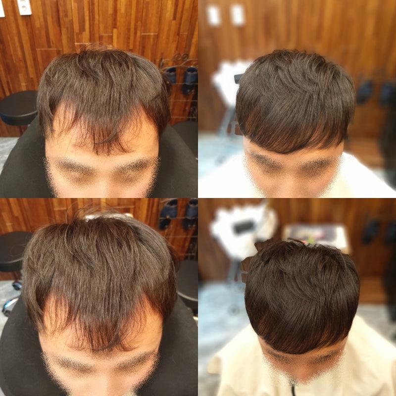 m자 탈모 이마 넓은 남자 머리 헤어스타일 : 네이버 블로그 M자 탈모 이마 넓은 남자 머리 헤어스타일 : 네이버 블로그