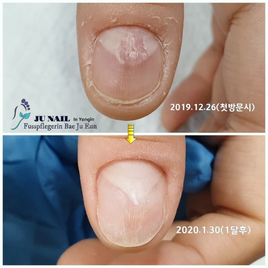 손톱이 파였을때 그냥 방치하지마세요. 1회관리후 후기/분당용인수원수지보정동백죽전동/주네일/무좀파고드는내향성발톱손톱변형전문네일샵 손톱이 파였을때 그냥 방치하지마세요. 1회관리후 후기/분당용인수원수지보정동백죽전동/주네일/무좀파고드는내향성발톱손톱변형전문네일샵