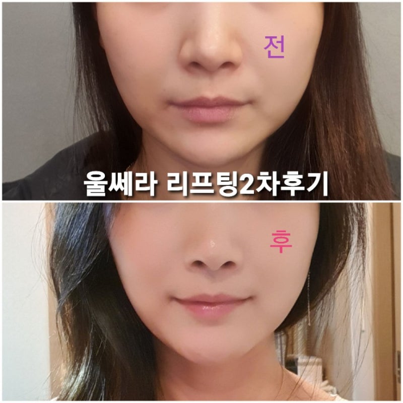 청담피부과 우르셀라300샷 맞이 후기
