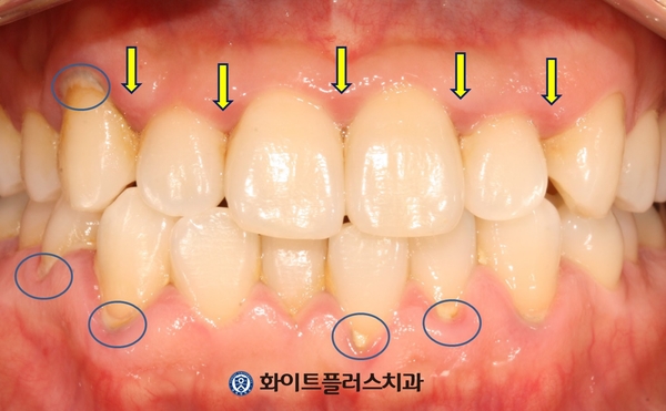  잇몸병은 잇몸약이나 먹는약으로 치료가 안될까? 신대방동치과