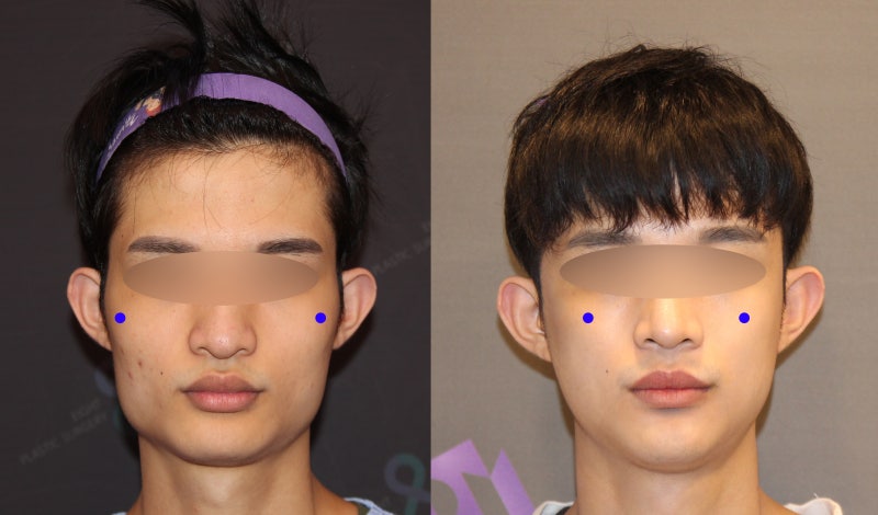 남자 안면윤곽 (사각턱수술, 광대수술, 턱끝수술) - 전문의가 알려드립니다. : 네이버 블로그 남자 안면윤곽 (사각턱수술, 광대수술, 턱끝수술) - 전문의가 알려드립니다. : 네이버 블로그