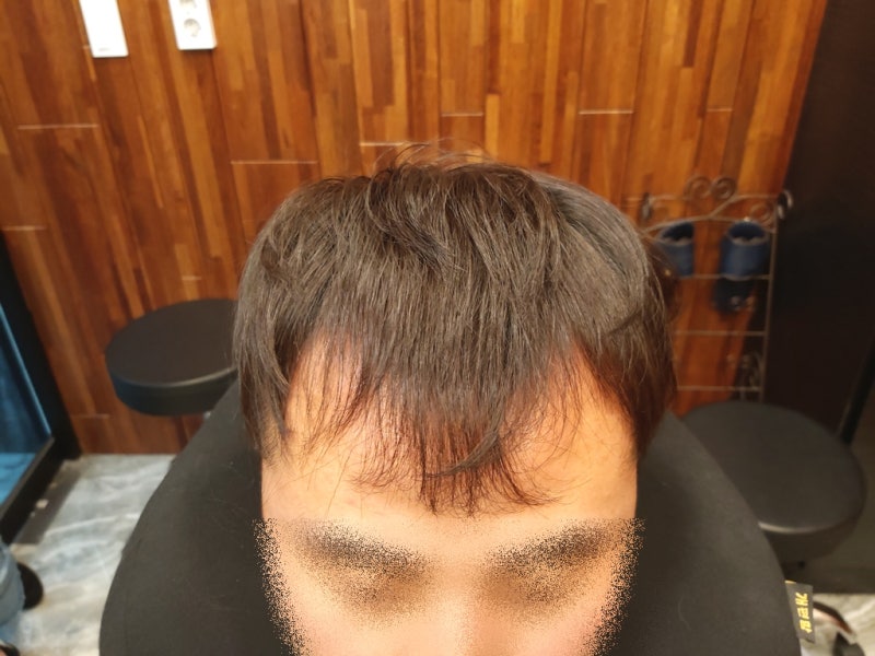 m자 탈모 이마 넓은 남자 머리 헤어스타일 : 네이버 블로그 M자 탈모 이마 넓은 남자 머리 헤어스타일 : 네이버 블로그