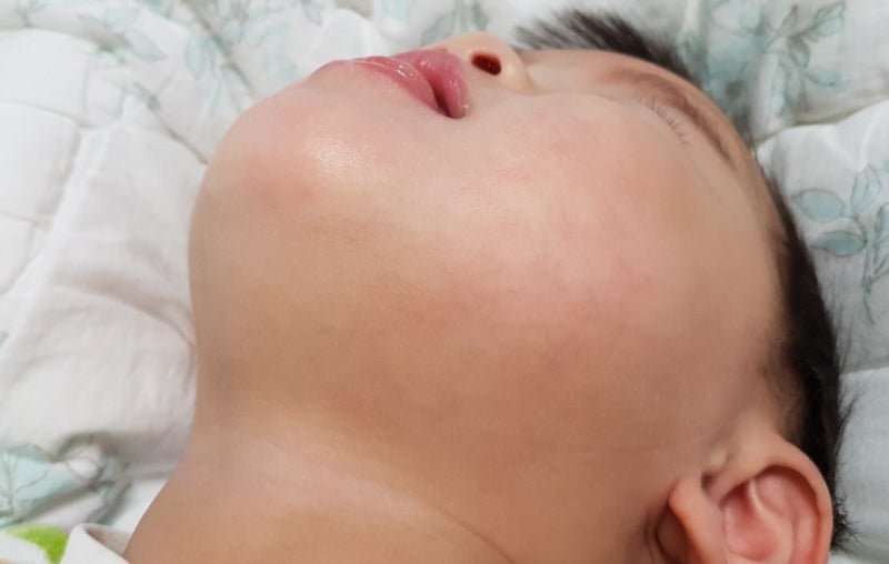 돌 이후 많이 좋아진 아기 얼굴 피부 (아토피/침구/피부염/보습제 리뷰) 2