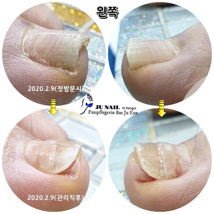 무좀으로인하여 발톱이 파고들면 내향성발톱으로 바뀔수있습니다./분당용인수원수지보정동백죽전동/주네일/무좀파고드는내향성발톱손톱변형전문네일샵 무좀으로인하여 발톱이 파고들면 내향성발톱으로 바뀔수있습니다./분당용인수원수지보정동백죽전동/주네일/무좀파고드는내향성발톱손톱변형전문네일샵
