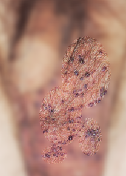 남자 속옷에 묻어나는 혈흔의 원인, 포다이스 혈관각화종 (Angiokeratoma of Fordyce)