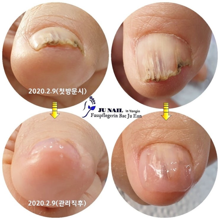 이천에서 용인까지 문제성손톱관리받으러 오셨네요/분당용인수원수지보정동백죽전동/주네일/무좀파고드는내향성발톱손톱변형전문네일샵 이천에서 용인까지 문제성손톱관리받으러 오셨네요/분당용인수원수지보정동백죽전동/주네일/무좀파고드는내향성발톱손톱변형전문네일샵