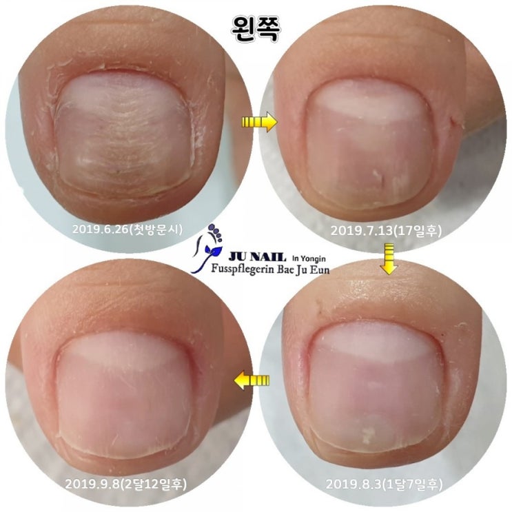 울퉁불퉁 주름진 빨래판손톱 관리후기입니다./분당용인수원수지보정동백죽전동/주네일/무좀파고드는내향성발톱손톱변형전문네일샵