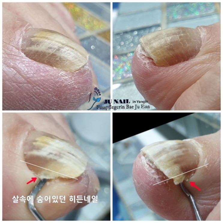 발톱에통증이 생겼어요. 엄지발톱이 자꾸아픈데 이유가 뭘까요/분당용인수원수지보정동백죽전동/주네일/무좀파고드는내향성발톱손톱변형전문네일샵 발톱에통증이 생겼어요. 엄지발톱이 자꾸아픈데 이유가 뭘까요/분당용인수원수지보정동백죽전동/주네일/무좀파고드는내향성발톱손톱변형전문네일샵