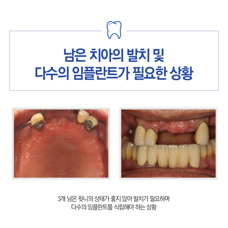 윗니 전체 임플란트 선택 전 고려사항