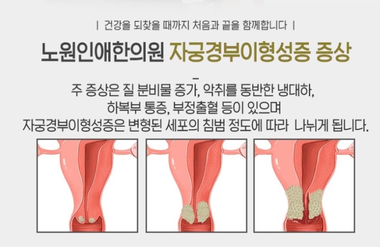  자궁경부암 바이러스, 경부이형성증치료방법,hpv바이러스 무서운거에요