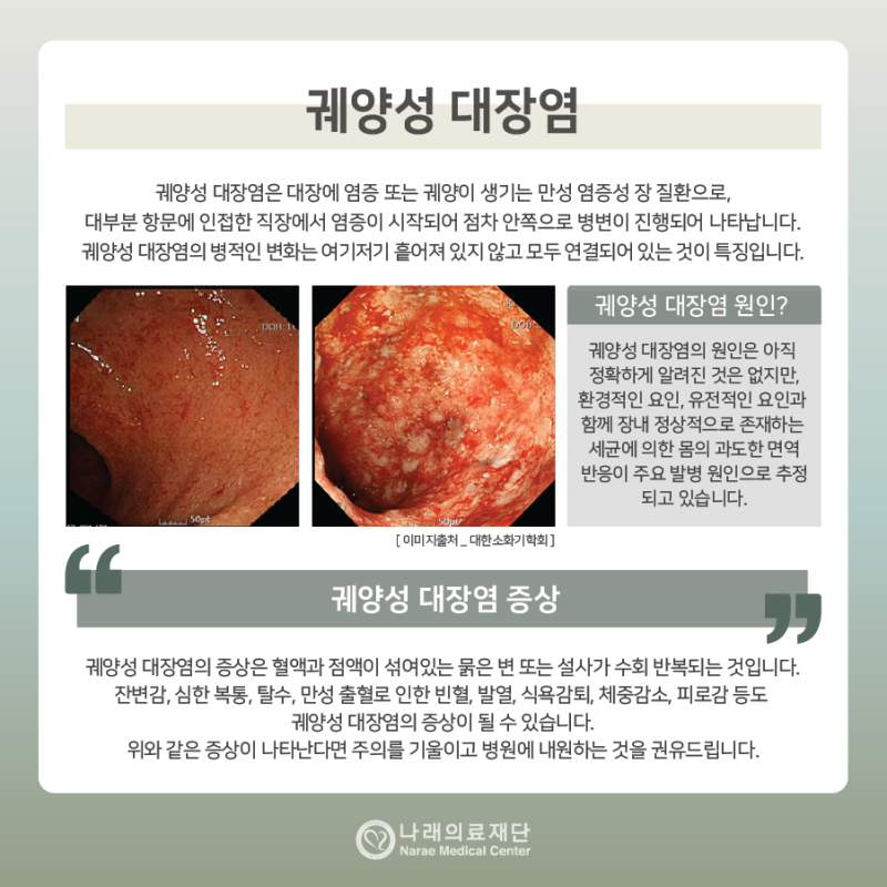 궤양성 대장염 크론병 완치 어렵지만 중요한 관리