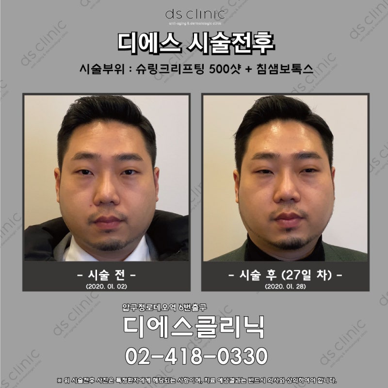 장성규 슈링크 받은 거 보고 병원에서 500샷 시술 전후