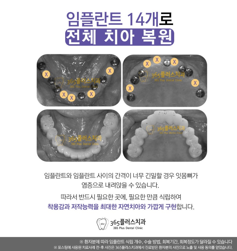 하남임플란트치과 임플란트 총비용 알아보기