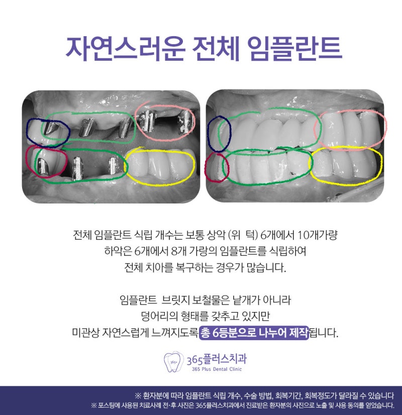 하남임플란트치과 임플란트 총비용 알아보기 7