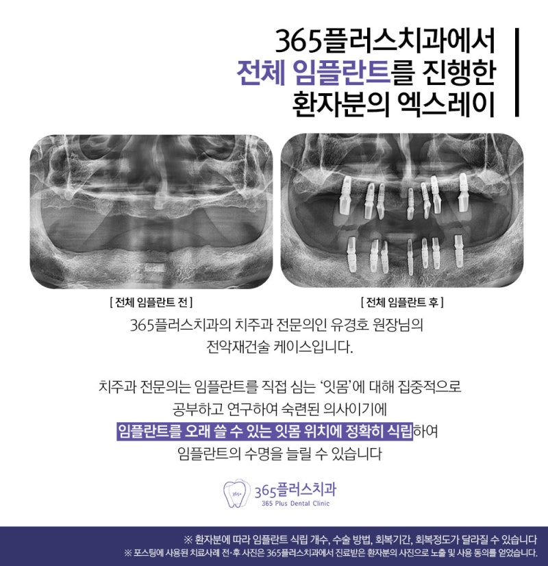 하남임플란트치과 임플란트 총비용 알아보기 4