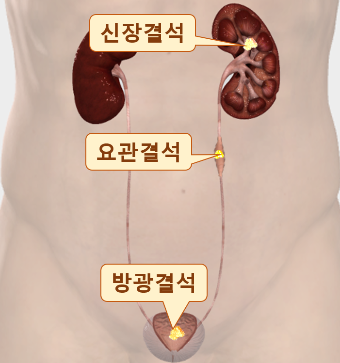  [울산 비뇨기과] 무증상, 증상이 없는 신장결석 치료해야 할까?