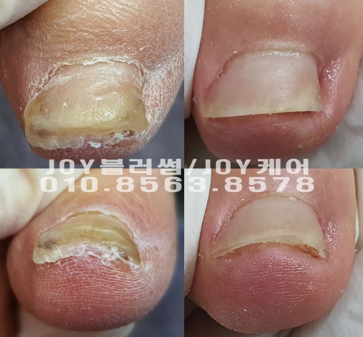  중풍환자분의 무좀발톱,파고드는발톱 관리도 가능한 용인,광교,수지 문제성발톱 전문관리 네일샵 조이블러썸