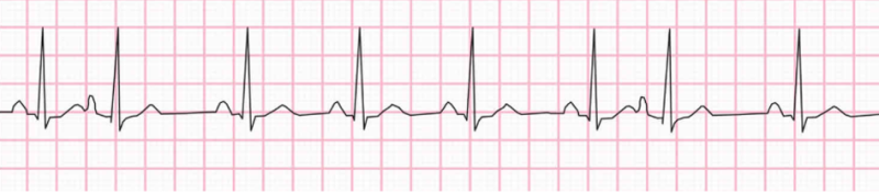 심방조기수축(Premature atrial contraction, PAC) 심전도 원리이해 : 네이버 블로그