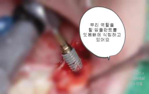  임플란트수술과정과 치료기간은 얼마나 걸릴까요?