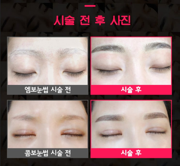  피부과체험단 모집합니다. 빼리오주사, 반영구화장, 인디고리프팅, 울트라스킨리프팅, 아쿠아필