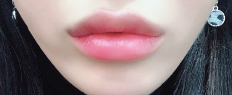  피부과 VVIP가 말해주는 입술필러 (멍, 붓기, 부작용, 통증)