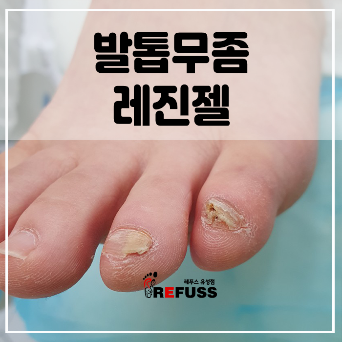 기름진 무좀을 제거하는 방법 공유