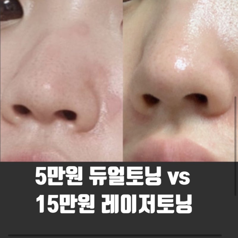기미, 주근깨, 색소침착 레이저토닝 시술후기 1 (플랙셀 듀얼, BBL 쥬레이저, 레브라이트) 3