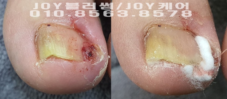  용인,광교,수지 발톱이상증상 전문관리 네일샵 조이블로썸 염증발톱의 고통에서 벗어나고 싶으신 고객님의 방문기