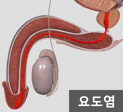  남자 비임균성 요도염의 증상과 검사