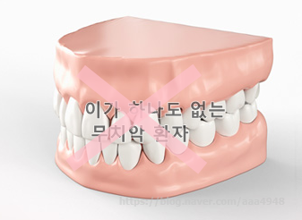  건강보험임플란트적용대상자,그기준은?