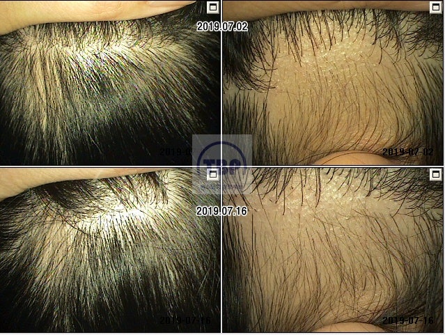 (30대 여성 2차 탈모치료) 강남타로병원에서 천만원? 그 후~ 2부!