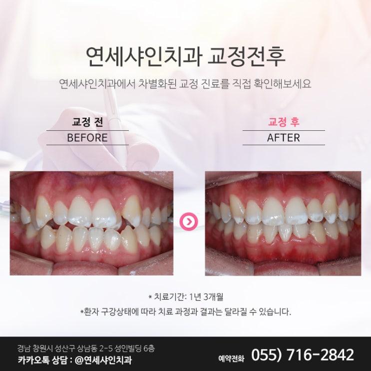  창원치아교정, 주걱턱 및 골격성 부정교합 사례