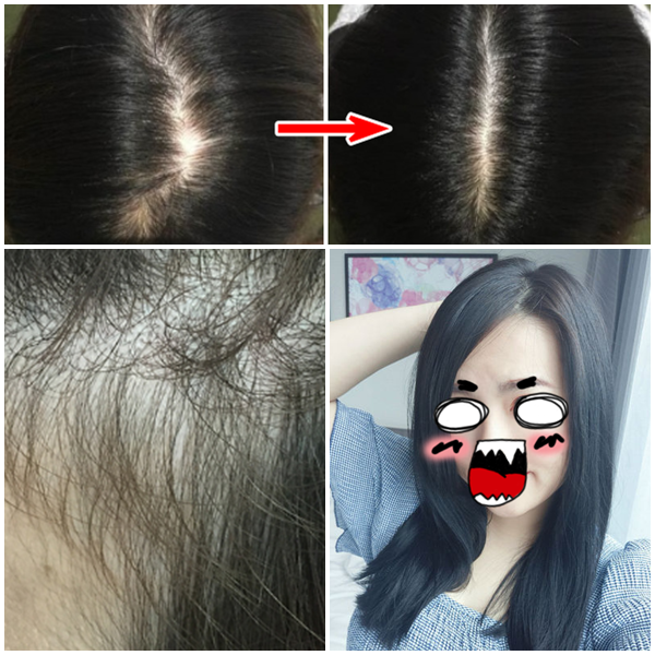  여성 정수리두피문신가격 비싸서 집에서 케어했어요