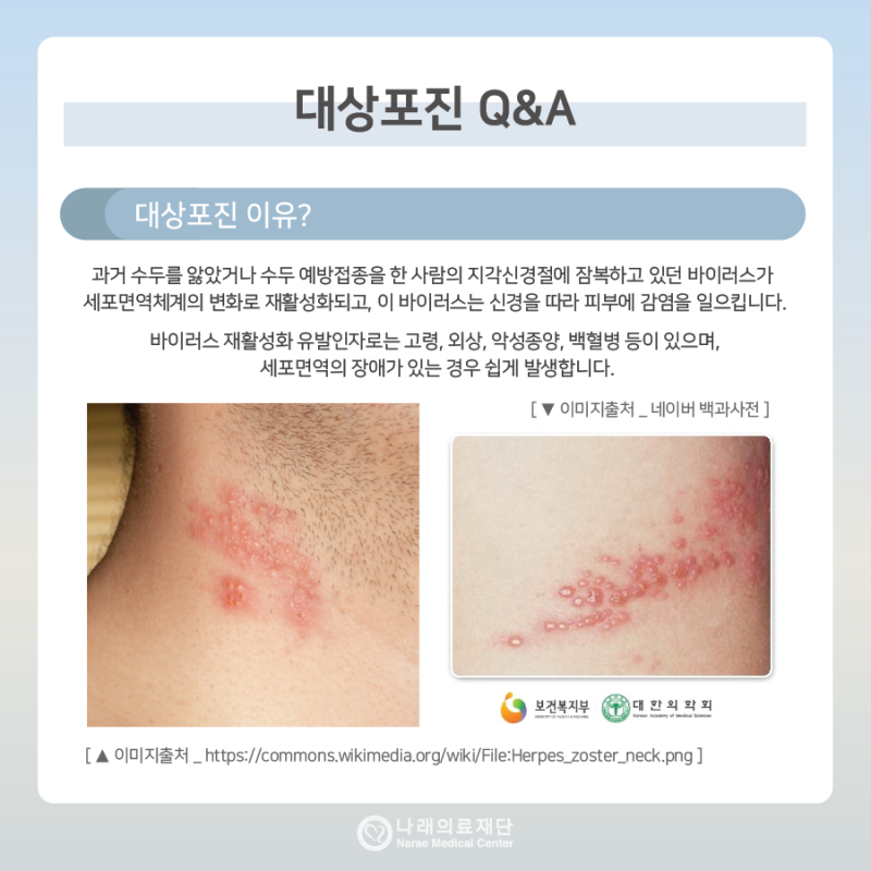 대상포진 예방접종의 모든것 초기증상 3