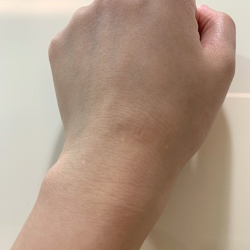 손목결절종 수술 대신 손목보호대로 나은 후기 3