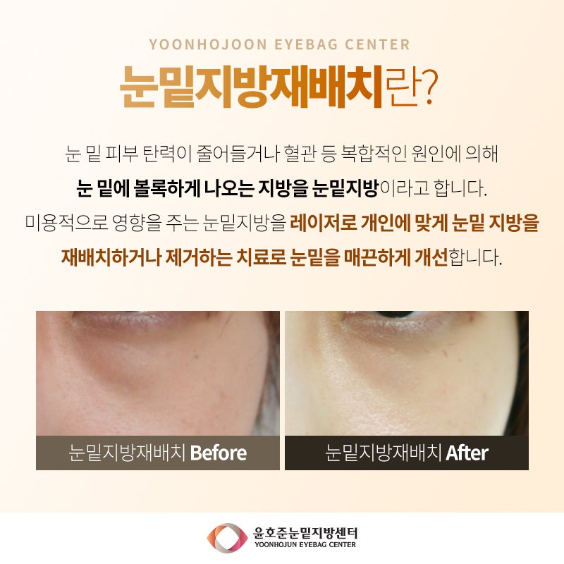 분당 눈밑지방재배치 눈밑 다크서클타입별 치료방법