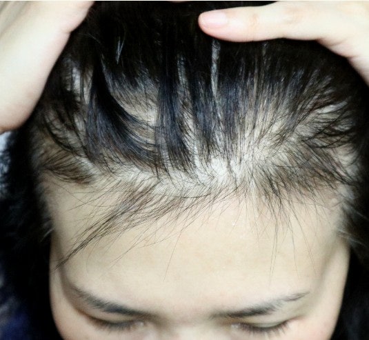 여자 앞머리 탈모가 빠지기 시작했나요? 8