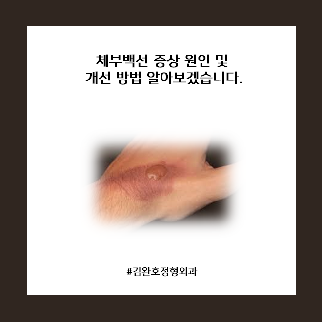 체부백선 증상 원인 및 개선 방법 알아보겠습니다. : 네이버 블로그