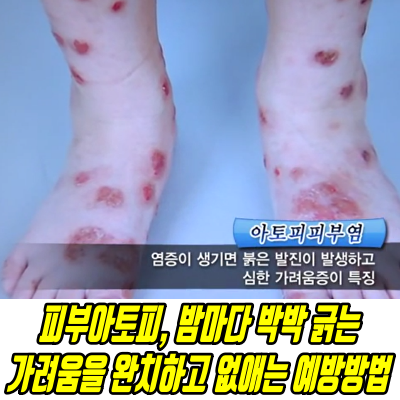 아토피 피부염, 아토피 증상, 아토피 치료 방법, 아토피 예방 습관 10