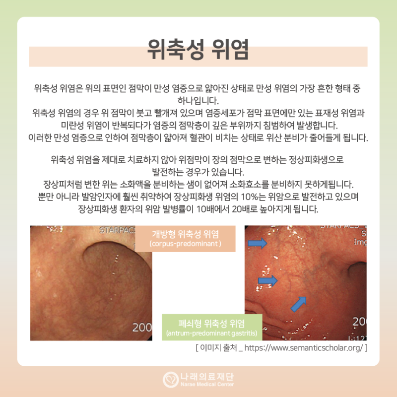 파주만성위염 위축성 미란성 표재성위염 장상피화생 역류성식도염 원인 6