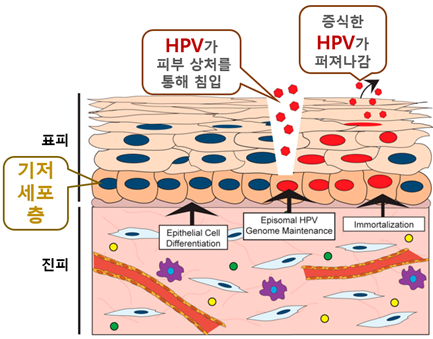  [울산 비뇨기과] 곤지름 재발 이유?