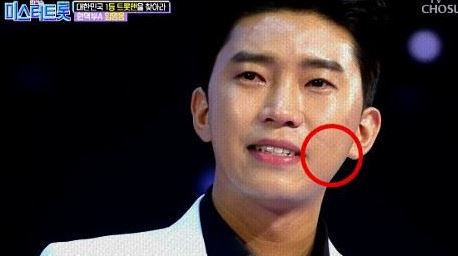  미스터트롯 임영웅 흉터 팬카페 등 이슈
